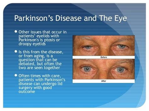 parkinson's symptoms eye problems